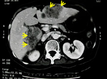 結腸癌出現肝轉移 (CT Scan電腦掃描影像)
