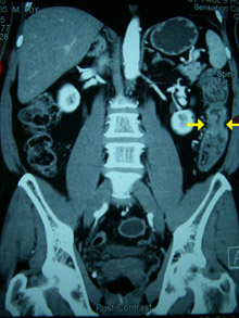 結腸癌 (CT Scan 電腦掃描影像)