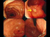 胃鏡顯示的十二指腸潰瘍影像
