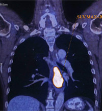 食道癌 – CT Scan 電腦掃描影像