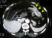 結腸癌 (CT Scan電腦掃描影像)